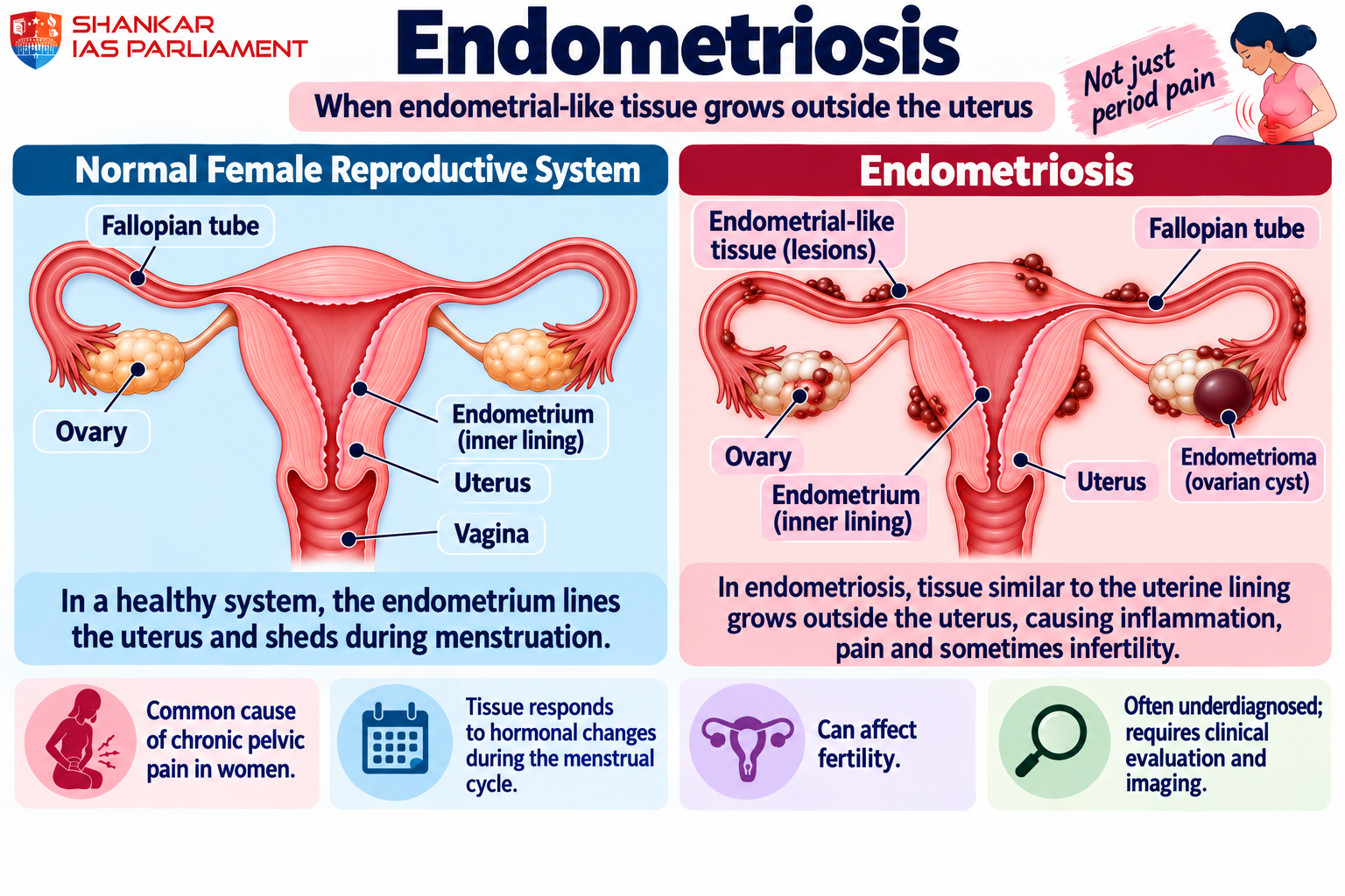 endometriosis upsc 2026