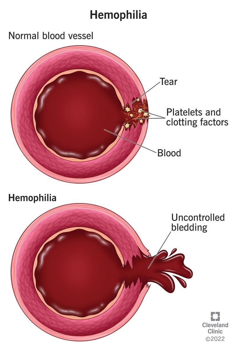 Hemophilia